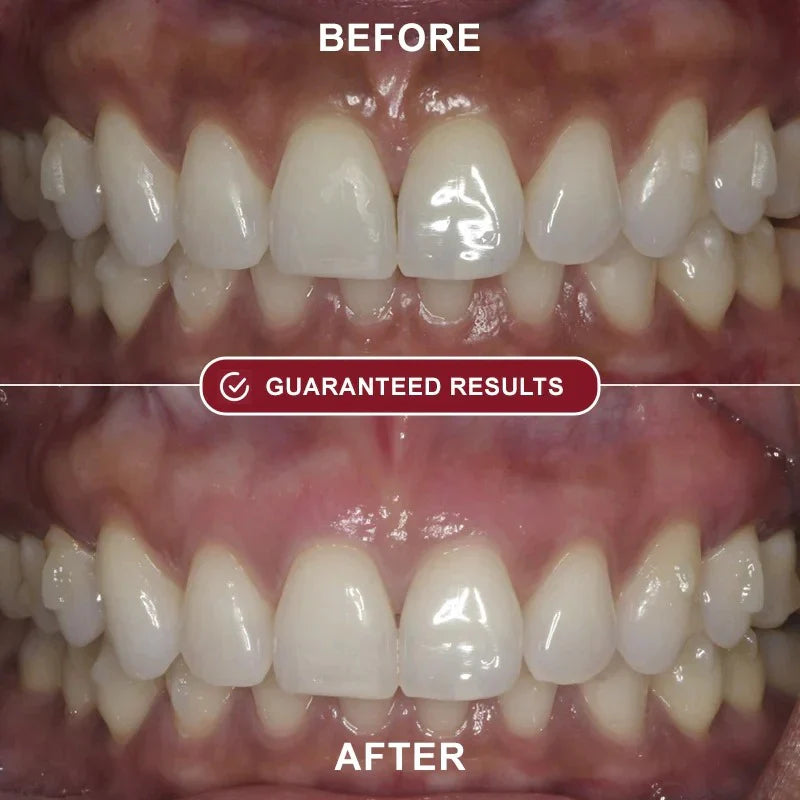 Evantory™ - Teeth Whitening Kit