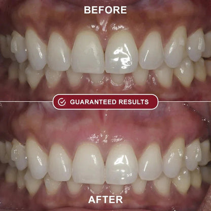 Evantory™ - Teeth Whitening Kit
